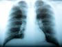 Grypa na Ukrainie mutuje i wypala płuca?